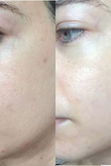 jade roller before and after photos