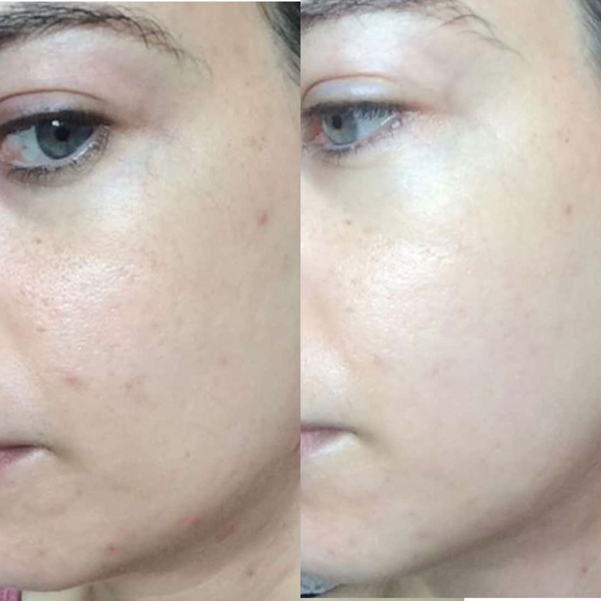 jade roller before and after photos