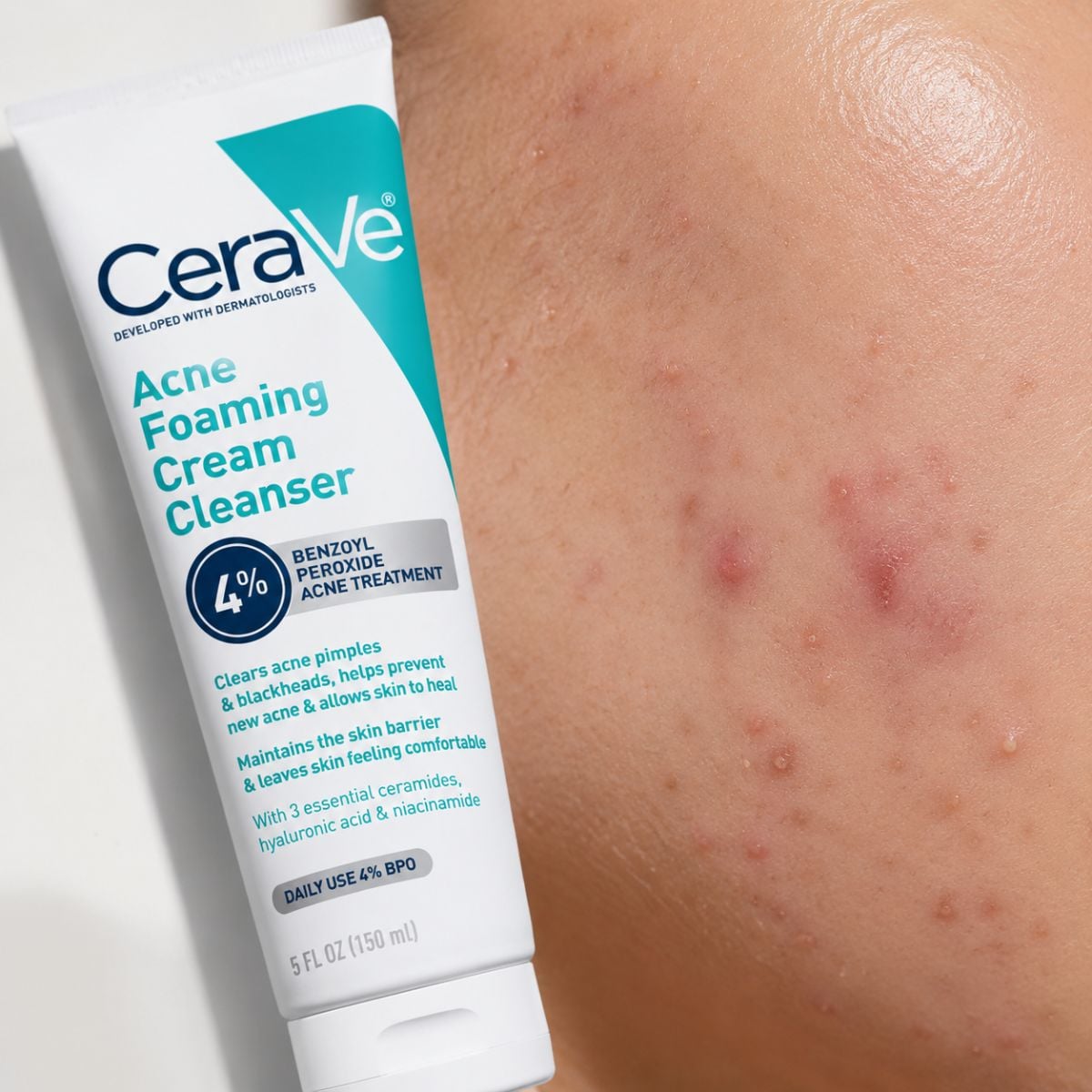 Best Cerave Products for Acne that will Clear Your Skin