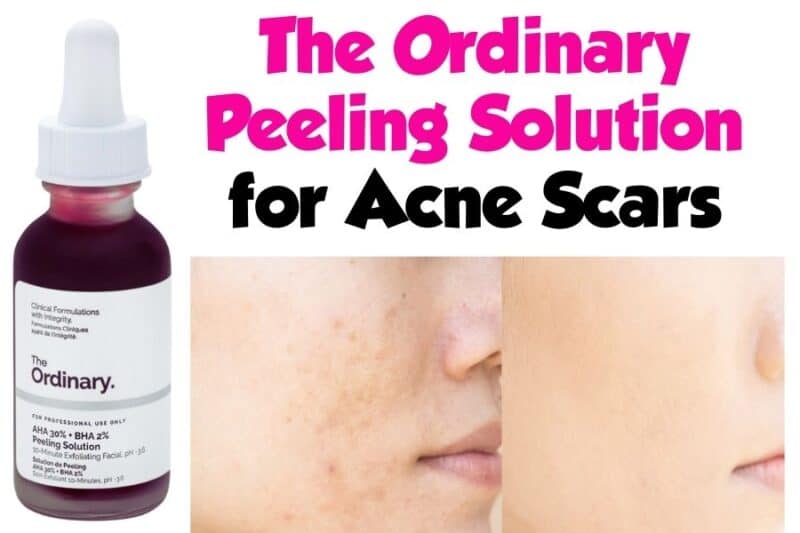 The Ordinary Peeling Solution for Acne Scars (AHA + BHA)