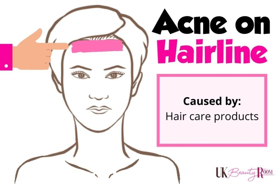 Acne Face Map What Your Acne is Telling You About Your Health