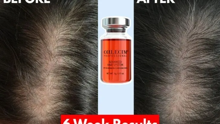 Does Calecim work for hair loss?