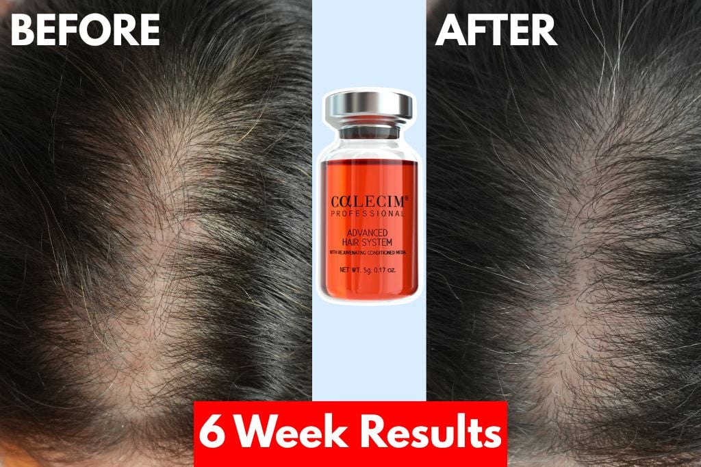 Does Calecim work for hair loss?