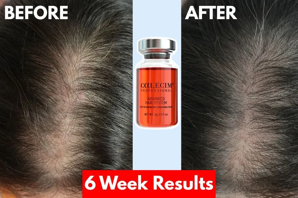 Does Calecim work for hair loss?